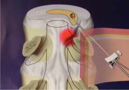 레이저 추간판 절제술 모식도.