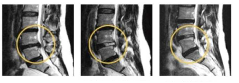 내시경 시술전 MRI, 내시경 시술 직후 MRI, 시술 3년 후 MRI.