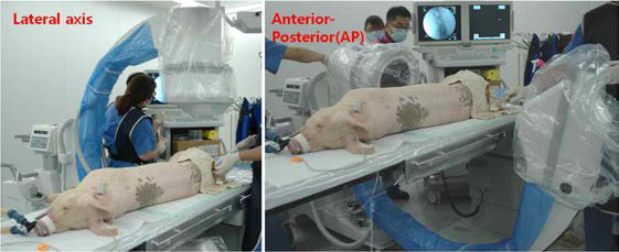 C-arm 조준 Lateral axis, Anterior-Posterior(AP)