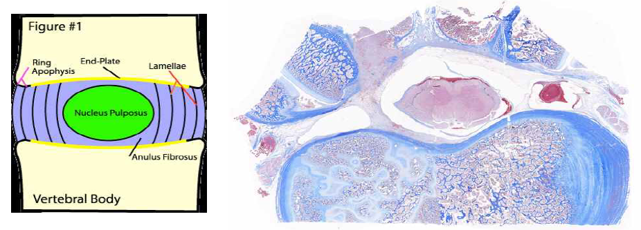 조직검사. 치료된 부분의 axial section에서 endplate와 vertebra 정 상으로 확인됨.