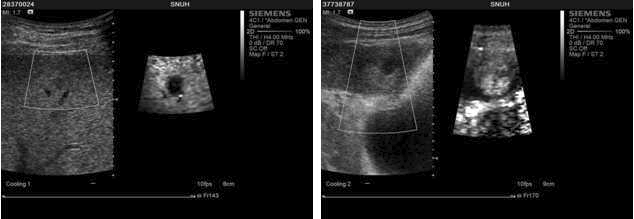 상대적인 변위의 대조도 영상기능이며, 좌는 Pancreatic Cancer, 우는 Duodenal Cancer