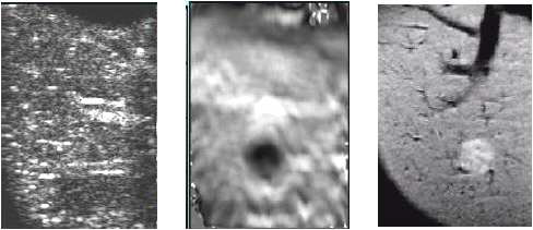 초음파 B-모드 영상(왼쪽), 초음파 탄성 영상(중앙), MRI 영상(오른쪽)의 비교