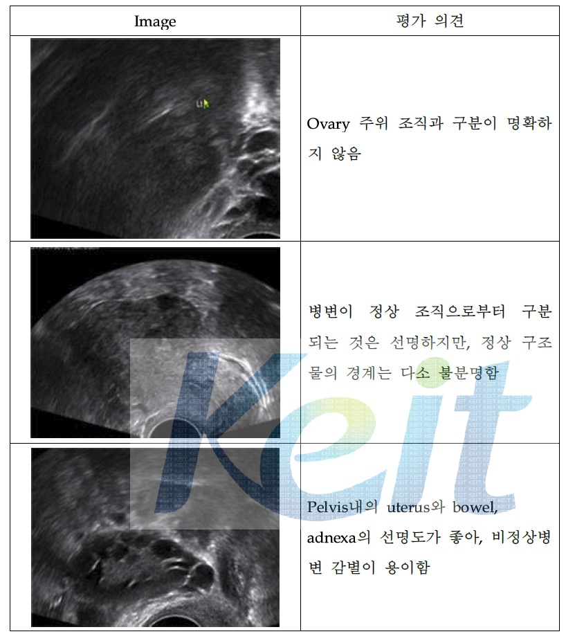 Gyn 평가 영상