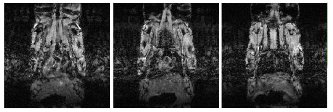 MRI 관찰시 호흡에 의한 artifact 및 어려움