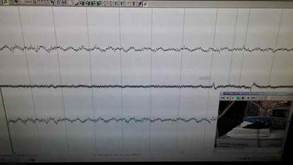 Recorded LFP Signals