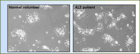 normal voluteer motor neuron과 ALS motor neuron