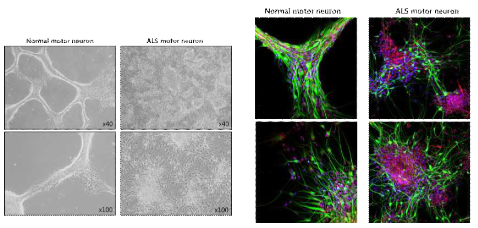 정상인과 ALS환자의 역분화 만능줄기세포에서 분화시킨 motor neuron의 비교