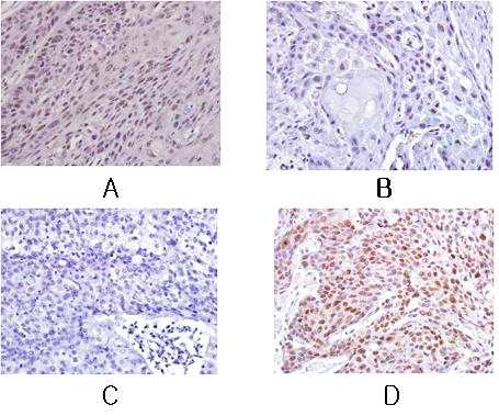 The expression of MTA-1 by immunohistochemical analysis in squamous cell carcinoma of the tonsil