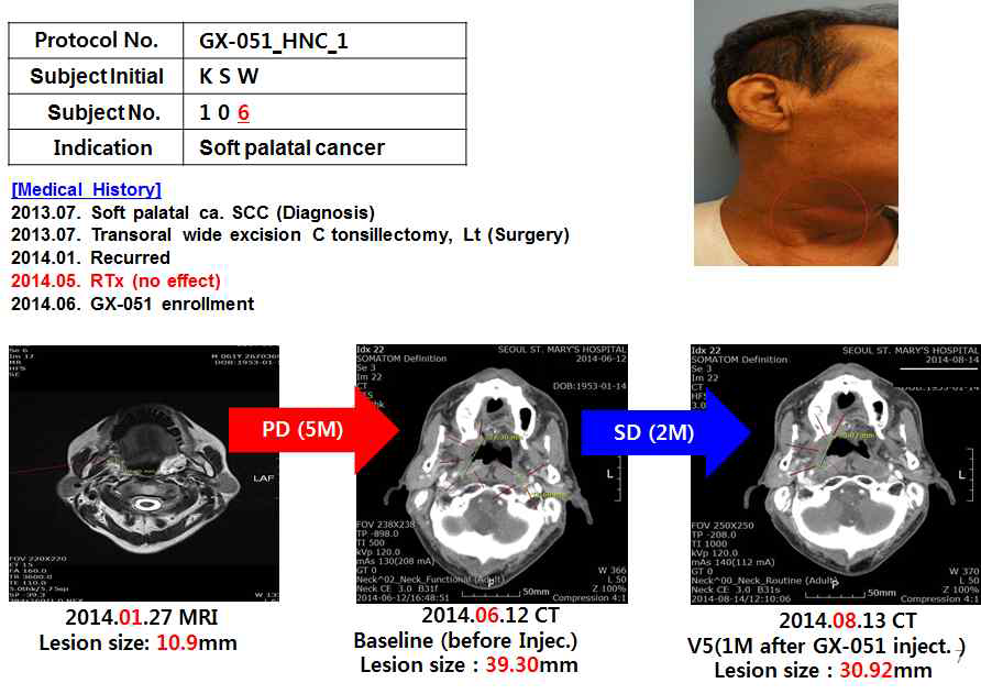 진행성 두경부암 환자에서 GX-051 투여 한 후 종양크기의 감소 확인