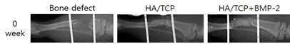 골이식재 삽입 후 X-ray 사진