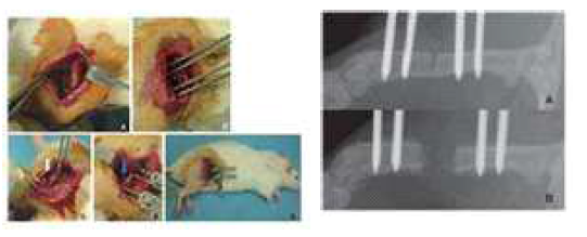 Femoral distraction 수술 과정과 뼈 절제술 후 7일, 12일에 찍은 X-ray 사진