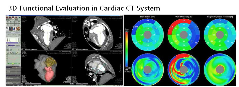 3D Cardiac CT를 이용한 좌심실 기능 평가