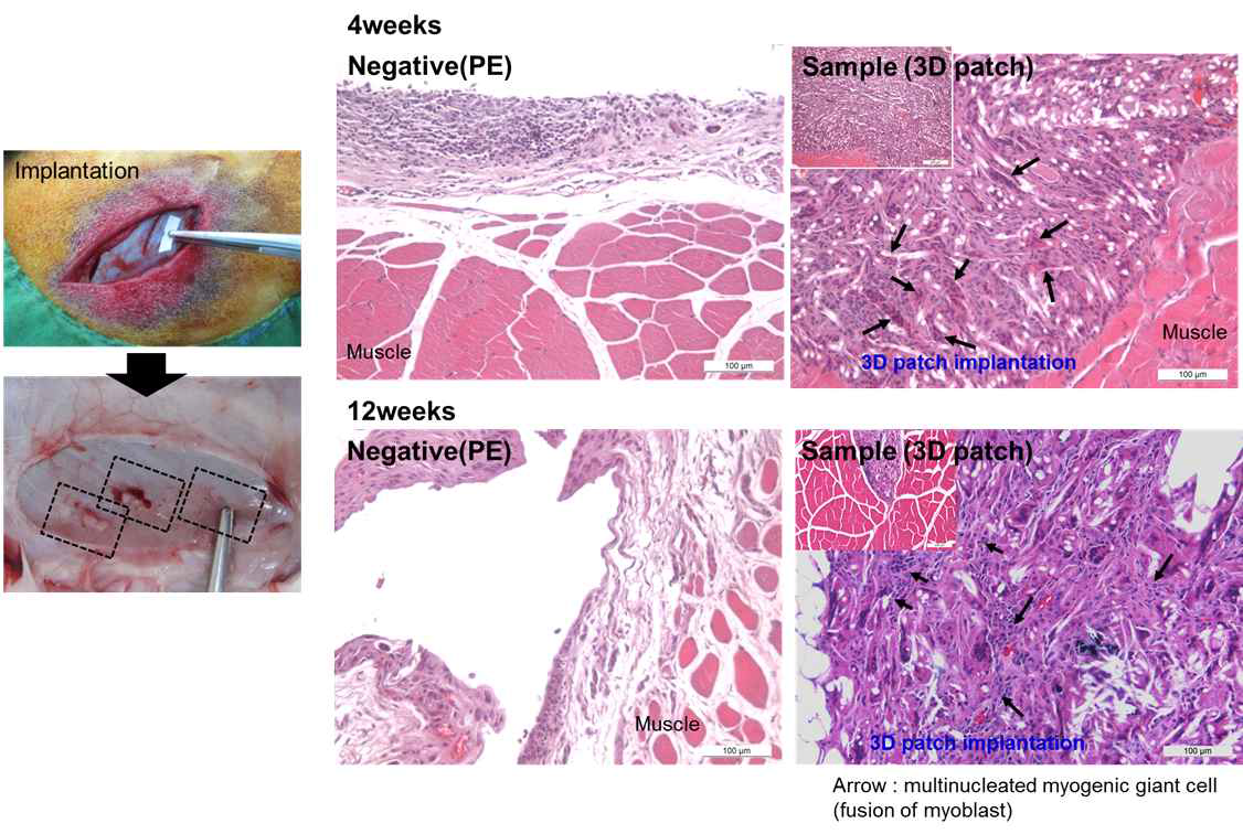 3D patch의 근육이식 결과