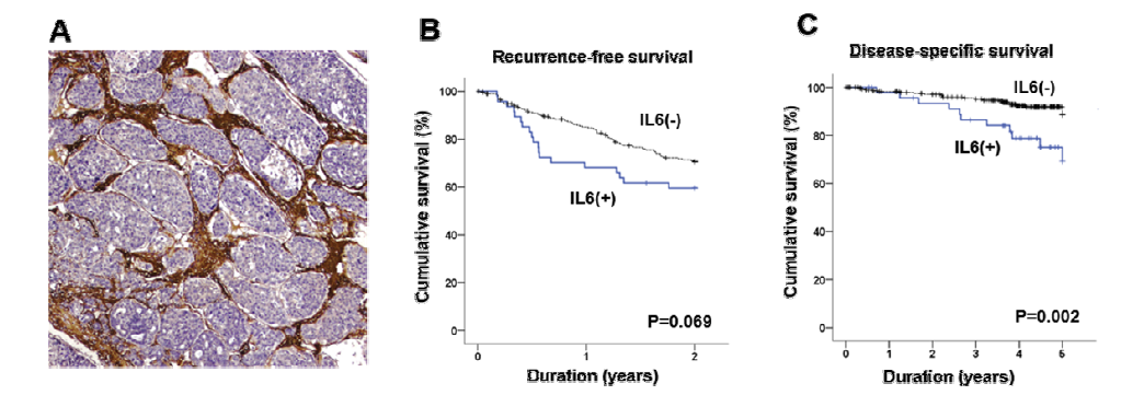 인체 간암 조직에서 IL6는 주로 stromal fibroblast에서 발현하며, stromal IL6의 발현량에 따라 disease-specific survival의 차이를 보임