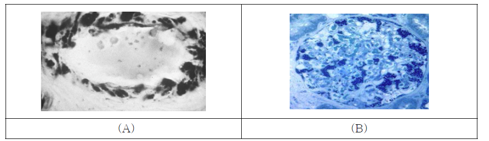 (A) Lipid deposit in blood vessel as demonstrated by sudan Black B staining. (B) Gb3-laden glomerulus