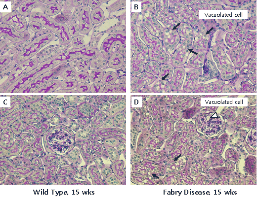 PAS staining; arrow, vacuoles in renal tubules; arrow head, vacuole in glomerulus; X200 in A & B, X100 in C & D