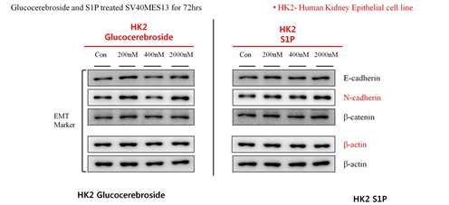 HK2 cell에 glucocerebroside, S1P를 처리하였을 때의 EMT 관련 유전자의 변화