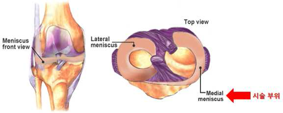 DMM(Destabilization of the medial Menisus) 시술 부위