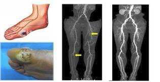 족부말초동맥질환 (PAD) 모습 및 실제 혈관 CT 촬영 사진