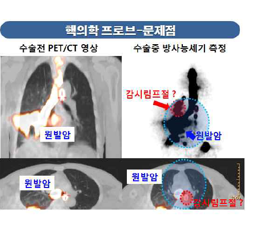 핵의학 프로브의 문제점