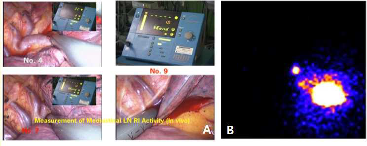 방사선의약품을 이용한 폐암에서의 감시림프절 탐색 (A) 수술용 감마 probe (B) 림프관조영술 on SPECT