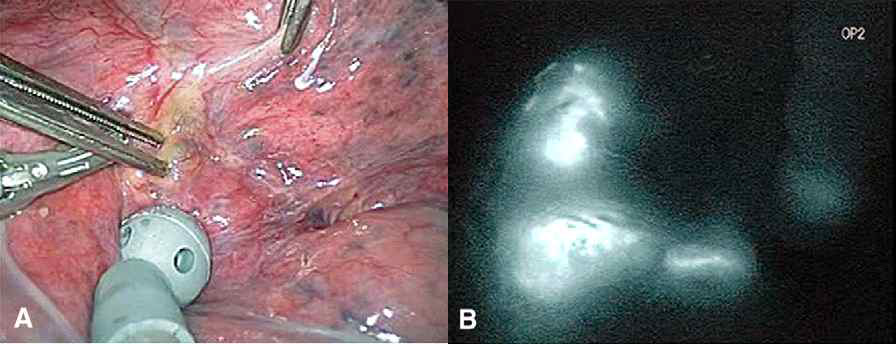 폐암에서 흉강경하 ICG 형광 감시림프절 영상 A 흉강경 영상, B 형광 영상