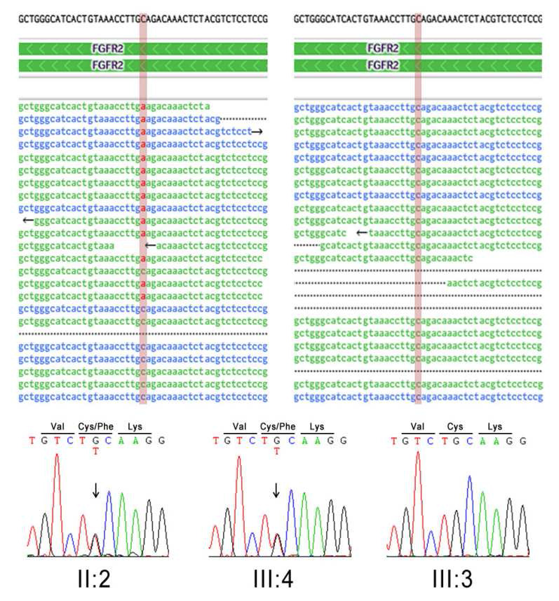 가계 내 Crouzon 증후군 환자와 정상인의 whole exome sequencing결과와 direct sequencing결과