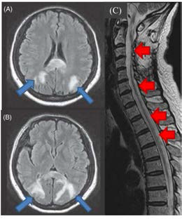 시신경 척수염 환자에서 흔하게 관찰되는 광범위한 중추신경계의 신경손상 (청색 화살표)을 보여주는 뇌 (brain)와 반복되는 염증으로 인해 심하게 위축된(atrophied) 척수(적색 화살표)의 자기공명영상(magnetic resonance image, MRI) 사진