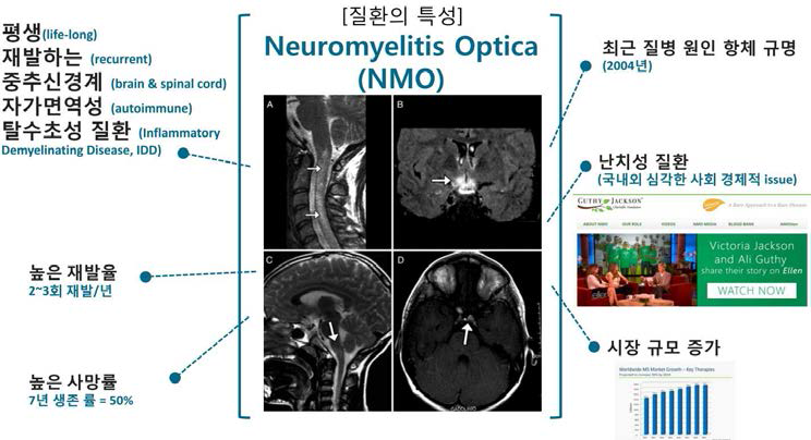 시신경척수염 (Neuromyelitis Optica, NMO)의 특징