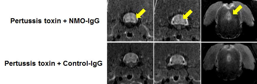 Pertussis toxin을 이용하여 혈뇌장벽을 파괴하고 NMO-IgG를 정맥내투여한 모델의 cervical spine과 spinal cord에서 NMO 병변이 관찰
