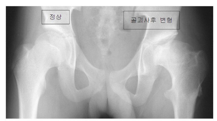 대퇴골두 무혈성 괴사후 관절의 변형이 발생한 방사선 사진.