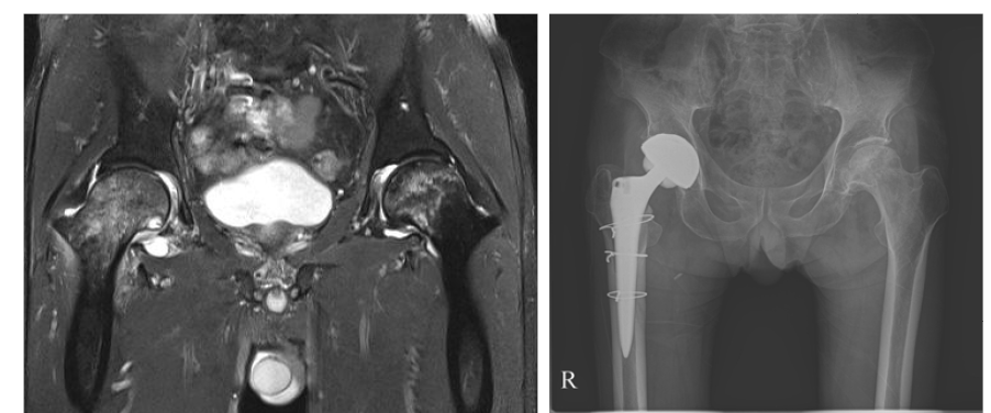 (A)양측 대퇴골두 무혈성 괴사의 MRI, (B) 우측 고관절에 대해 인공 관절술 시행 받은 상태임.