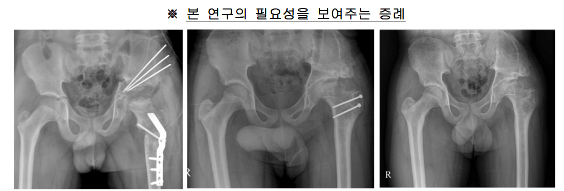 10세 남아의 좌측 대퇴골두 무혈성 괴사로 수차례 수술적 치료에도 불구하고 심각한 골변형이 발생함.