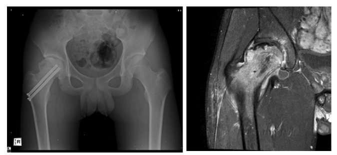 15세 남아의 우측 대퇴경부 골절후 외상성 대퇴골두 무혈성 괴사가 발생함