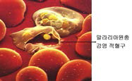 말라리아 감염 적혈구