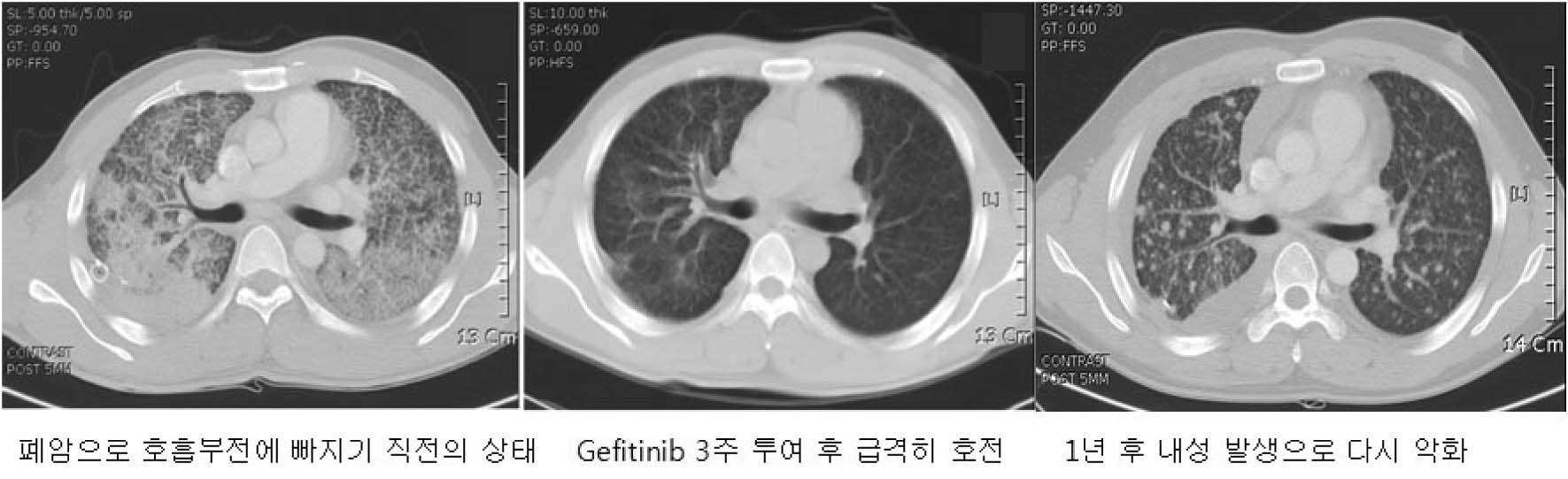 초기의 좋은 반응에도 불구하고 1년 후에 내성이 발생하는 전형적인 경과