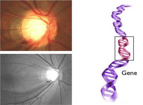 녹내장과 유전자