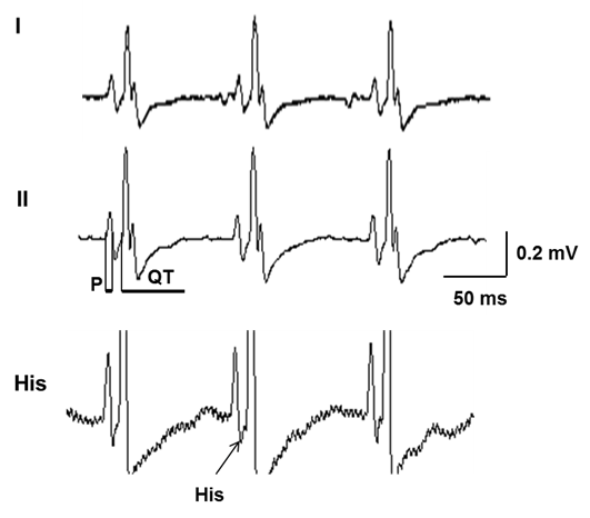 Corrected QT interval