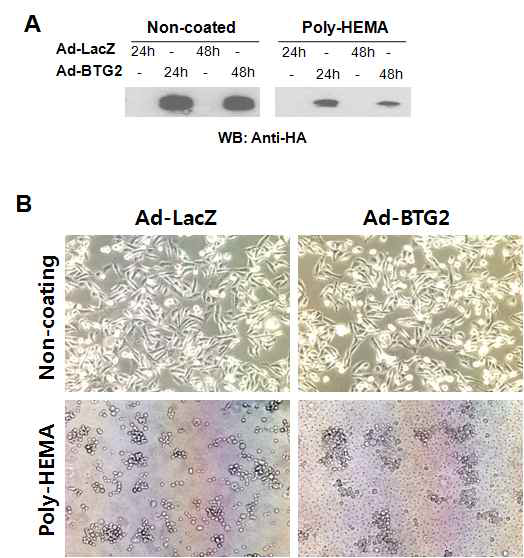 Anoikis assay after Ad-BTG2 infection in MDA-MB-231 cells