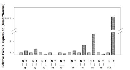 Twist mRNA expression in breast cancer tissues (N=normal,T=tumor)