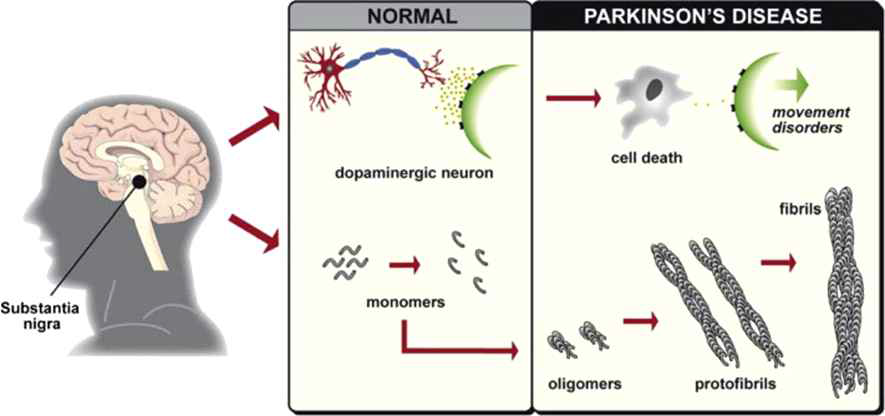 Formation of alpha-synuclein fibrils and the loss of dopaminergic neurons in the substantia nigra are observed in patients with Parkinson’s disease