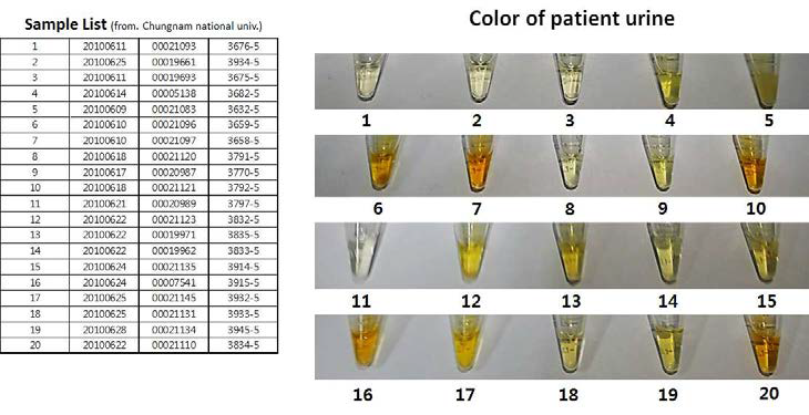 임상평가를 위해 사용 한 결핵환자의 소변 검체