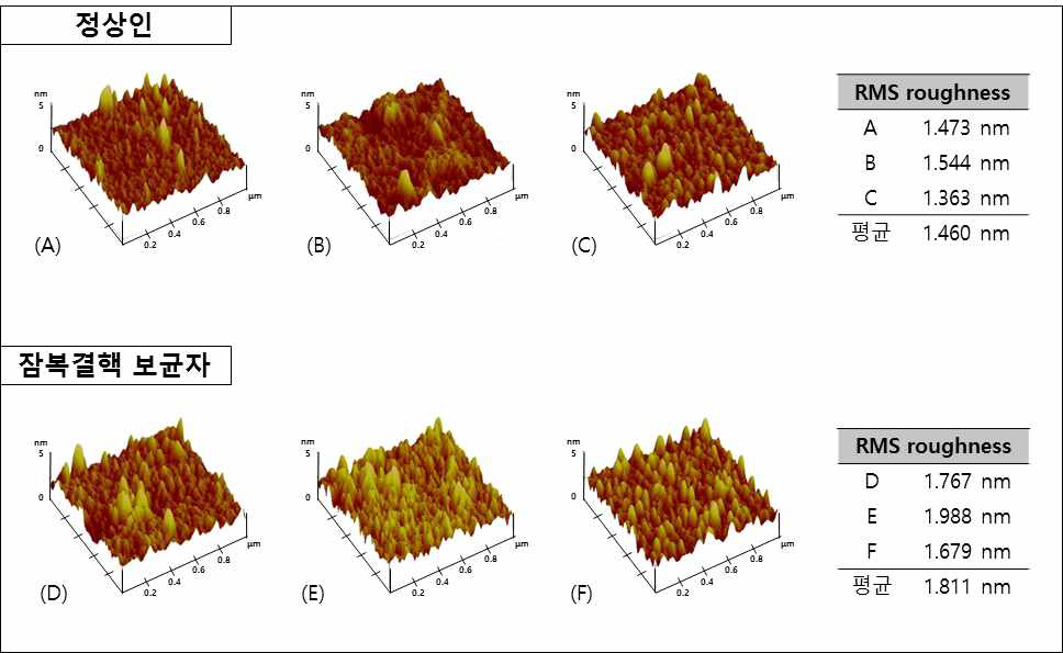 표면 고정된 항원과 정상인 및 잠복결핵 보균자 혈청의 반응에 따른 AFM 이미지 및 RMS rougness