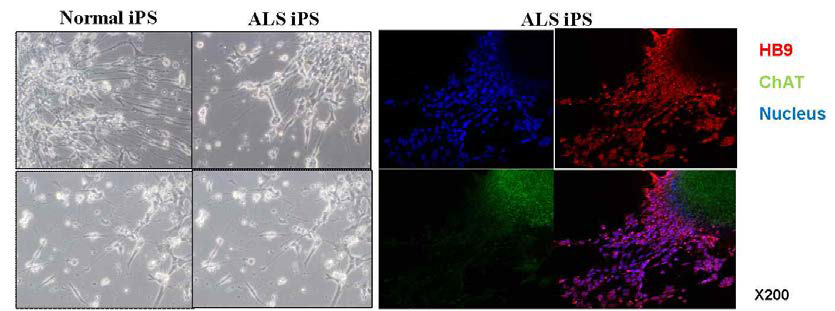ALS 환자유래 iPSCs로부터 분화유도된 운동신경줄기세포에서 HB9 및 ChAT의 발현 확인.