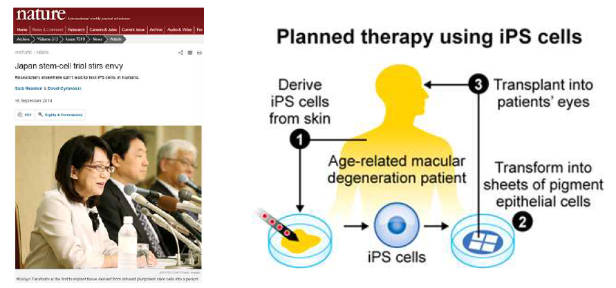 Masayo Takahashi 박사팀이 주도하는 유도만능줄기세포 임상연구
