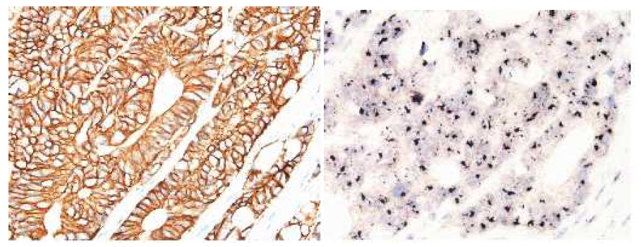 세툭시맙을 투여 받은 RAS 유전자 정상 전이성대장암의 HER2 IHC(좌)/SISH(우) 분석