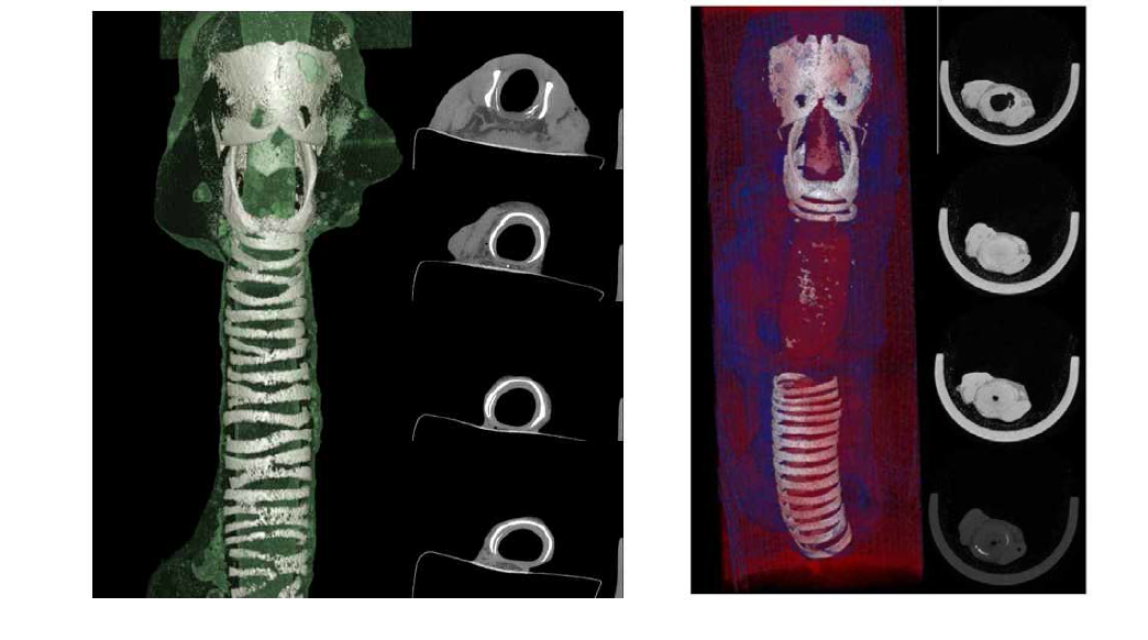 Micro CT 분석을 통한 기관 협착 정도 관찰법 확립. (좌) 정상 기관(normal trachea) (우) 협착(stenosis)이 유도된 기관지지체의 모습