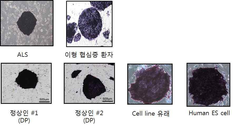정상인 또는 환자 유래 유도만능 줄기세포의 줄기세포능 검증 1 (ALP staining)