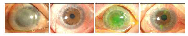 Secondary keratoplasty 시행 결과