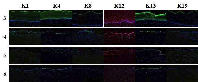 전층각막이식 시 제거된 각막의 cytokeratin 염색 결과